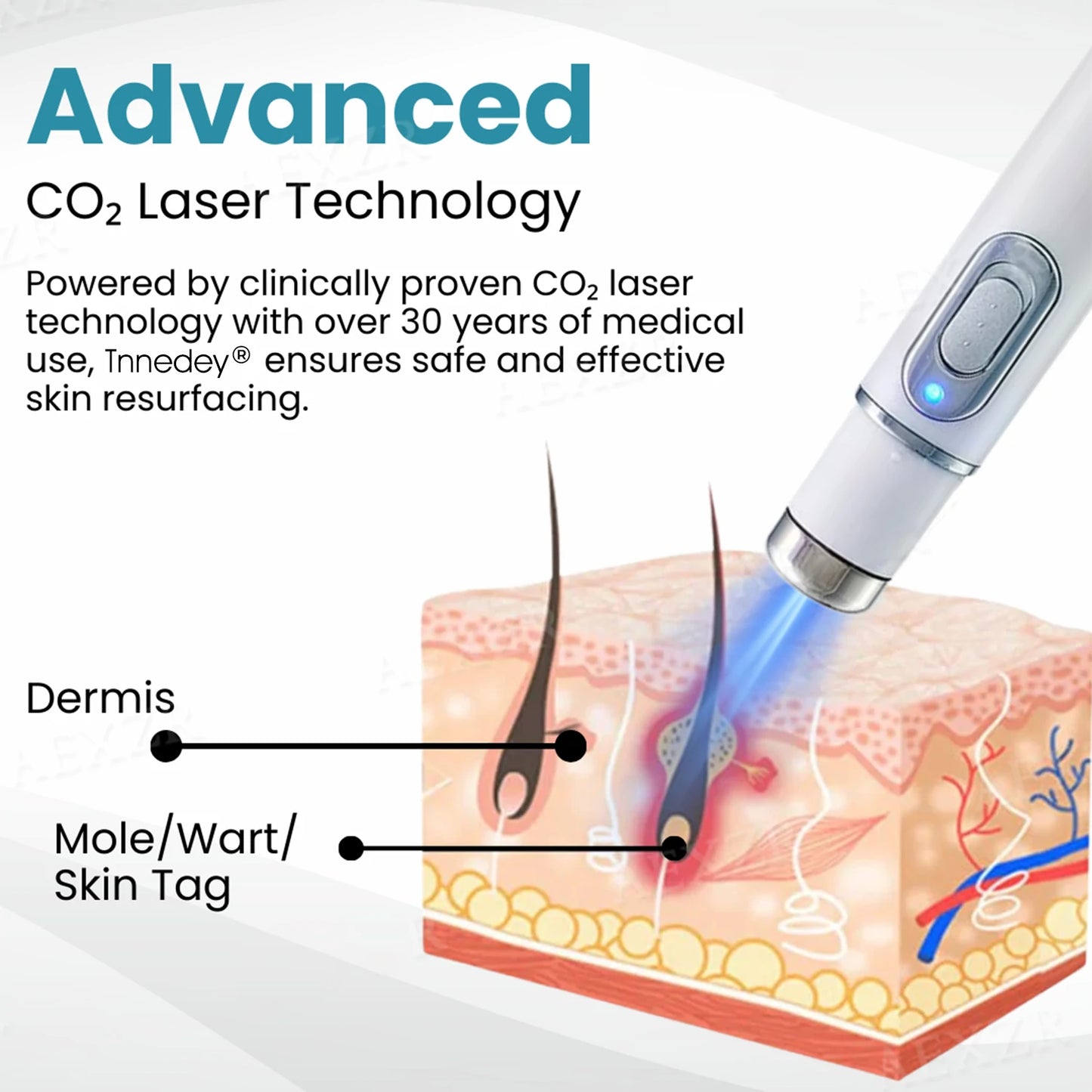 |Official Store| ✨Tnnedey®Non-Invasive Skin Imperfection Removal Pen✨