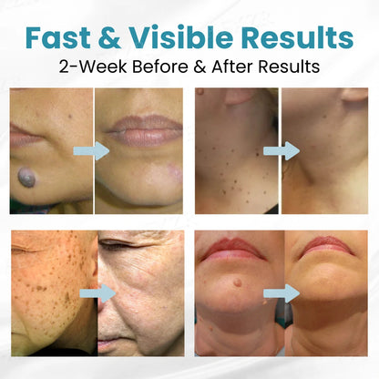 |Official Store| ✨Tnnedey®Non-Invasive Skin Imperfection Removal Pen✨