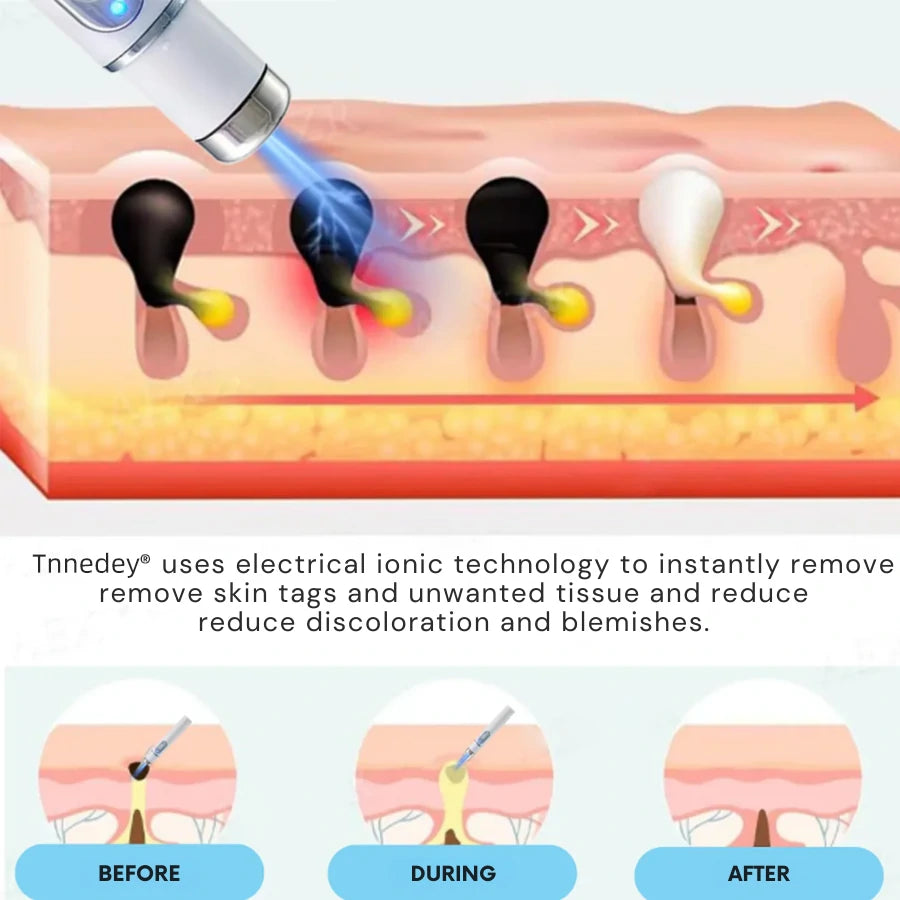 |Official Store| ✨Tnnedey®Non-Invasive Skin Imperfection Removal Pen✨