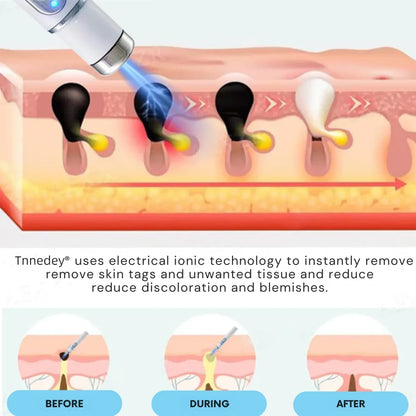 |Official Store| ✨Tnnedey®Non-Invasive Skin Imperfection Removal Pen✨